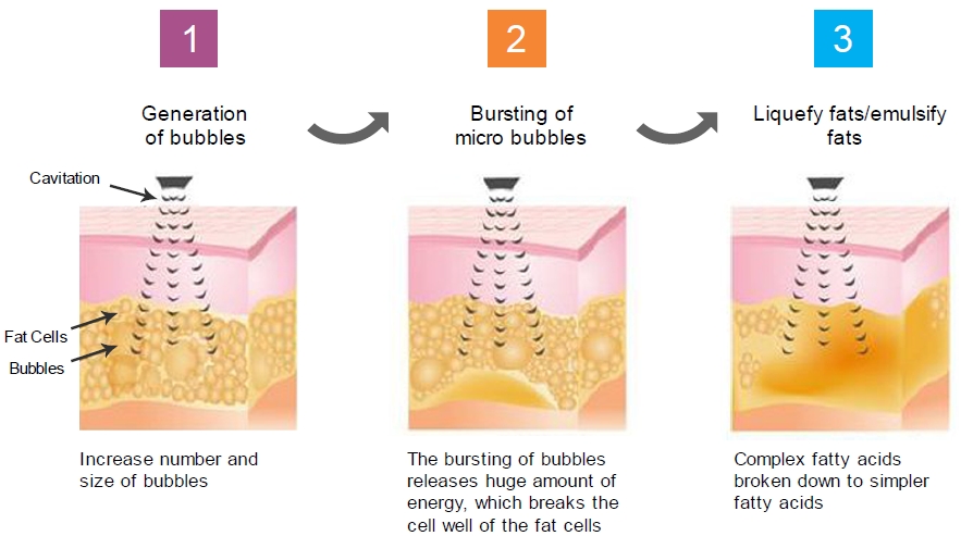 Ultrasound-body-contouring