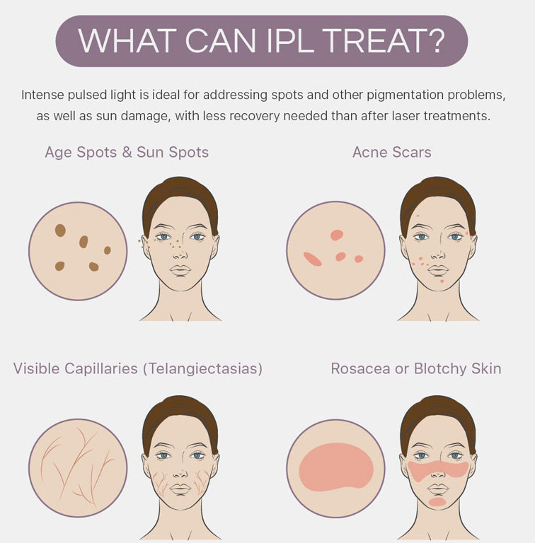 IPL-pigmentation