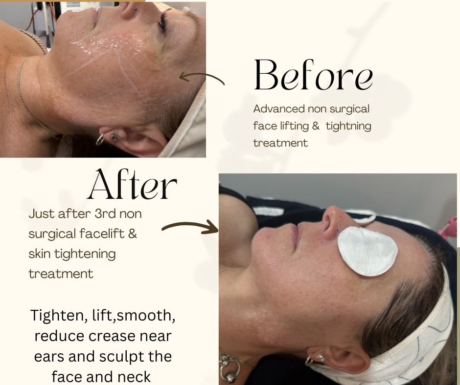 skin tightening brisbane