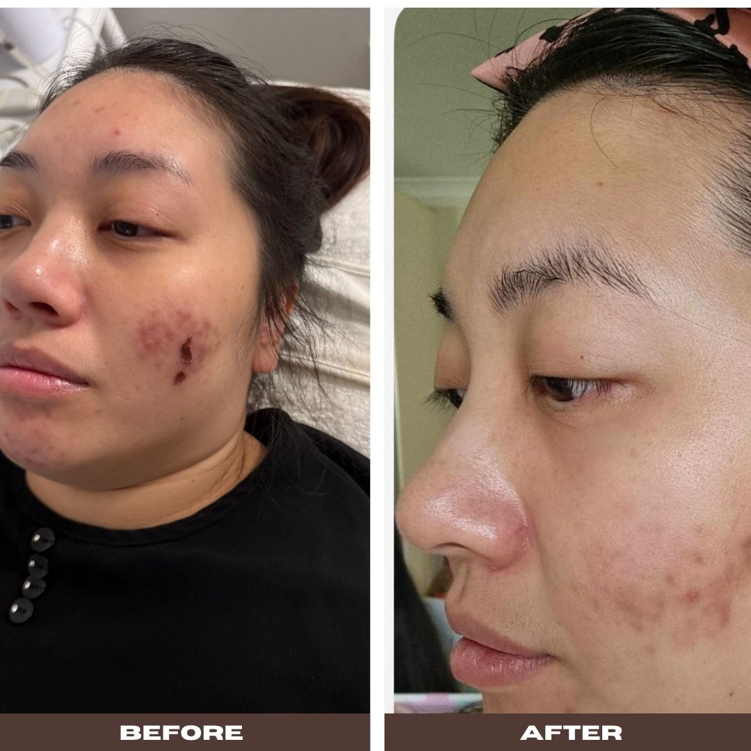 Visual transformation of acne treatment results from extraction facial Brisbane, displaying before and after effects.