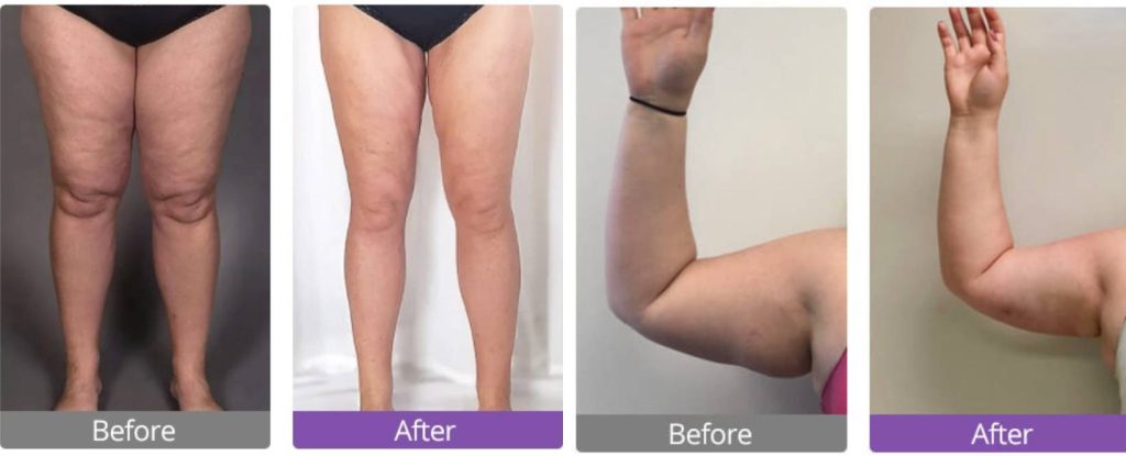 Diode Laser Fat Cavitation Before and After Photos