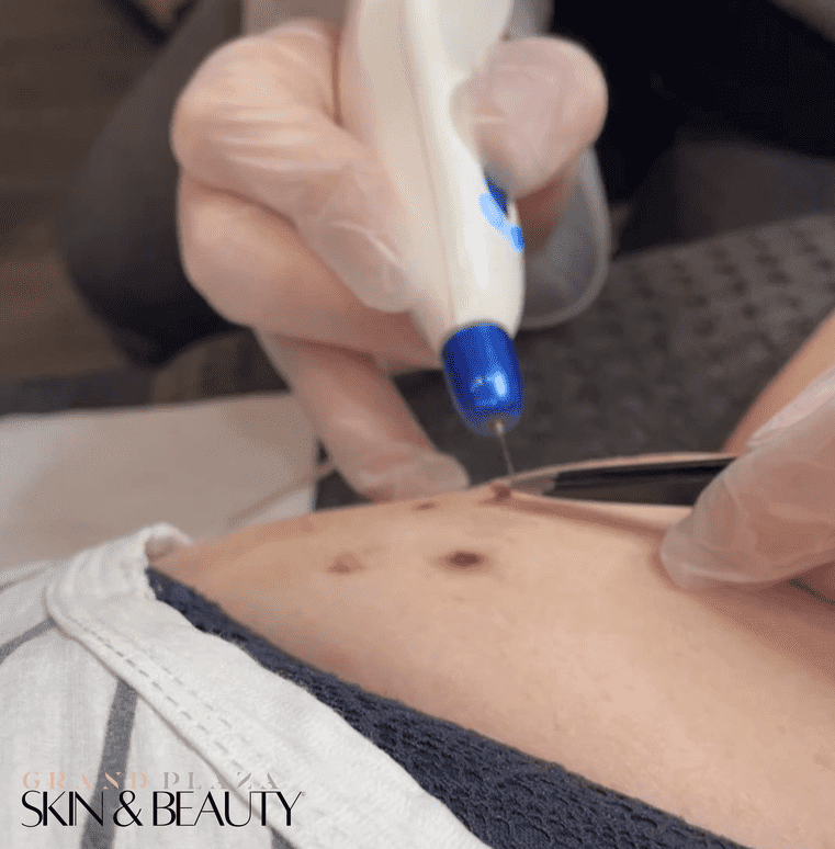 Skin Tag Removal in Browns Plains