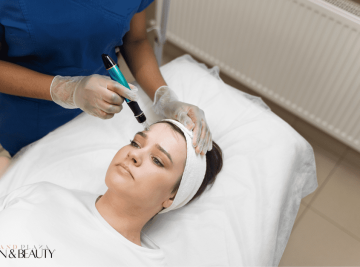 Skin Needling in Browns Plains Plaza