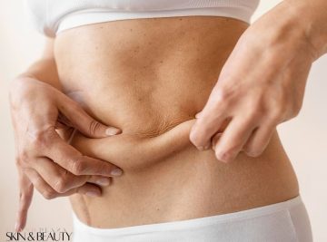 Close-up of woman pinching stubborn belly fat highlighting areas suitable for non-surgical fat reduction treatment in Brisbane