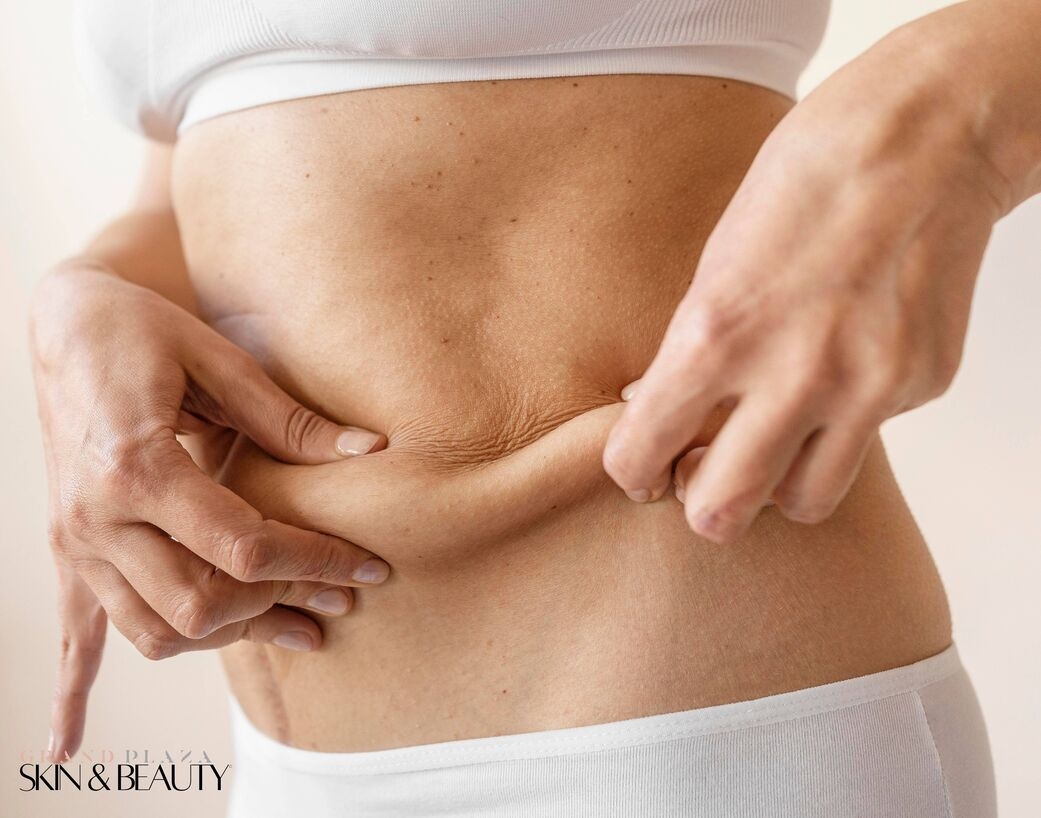 Close-up of woman pinching stubborn belly fat highlighting areas suitable for non-surgical fat reduction treatment in Brisbane